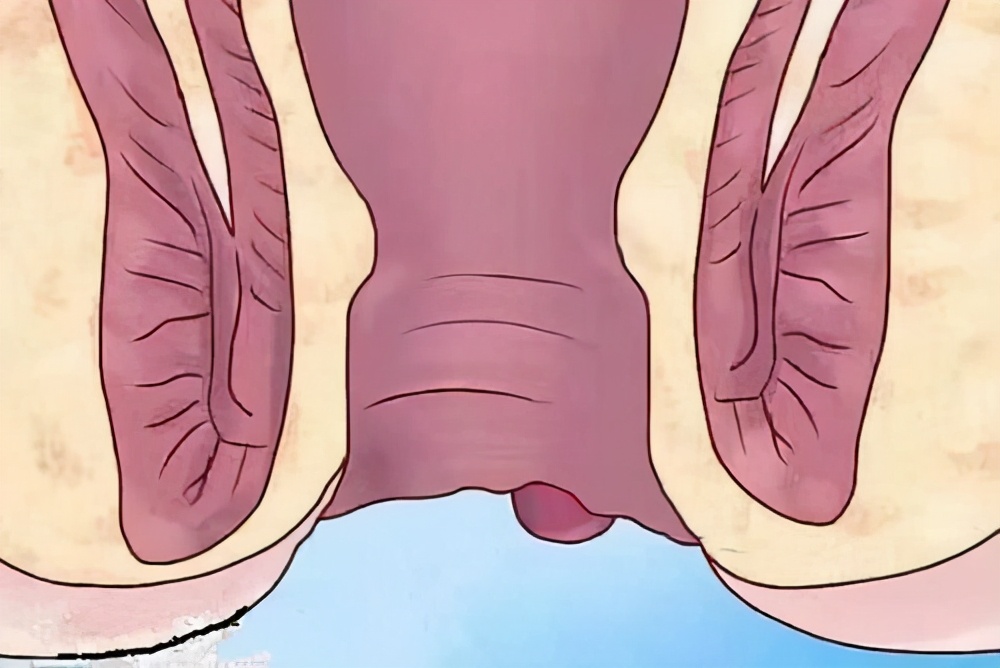 痔疮外痔图片(肛门外的小肉球和小肉疙瘩是什么) - 赤虎壹号