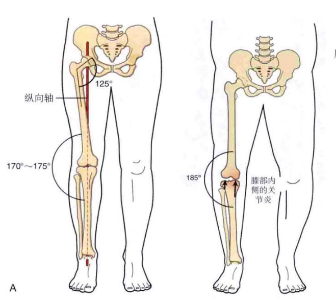 nba人为什么没有o型腿(詹姆斯也是O型腿，为什么他膝关节不疼，而我打篮球就腿痛呢？)