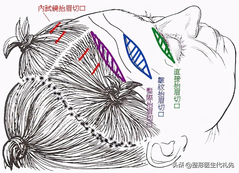 额头皮肤松弛出现横向抬头纹，眉毛下压应该怎么办？