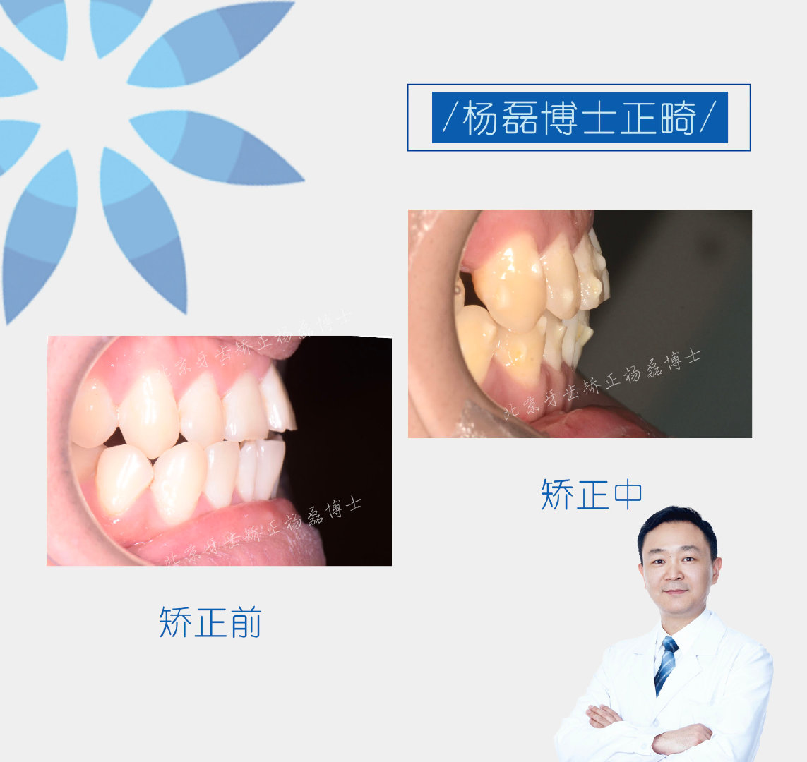 ​​杨磊博士 「骨性反颌偏颌正畸正颌联合治疗病例」