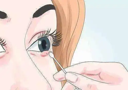 针眼长了怎么治疗？实用方法分享