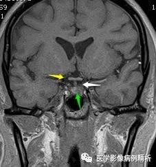 垂体柄阻断综合征并股骨头骨骺滑脱MR典型影像表现及分析思路