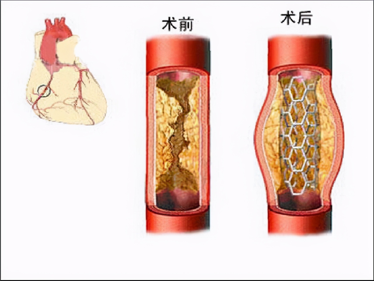 冠心病确诊，到底做冠脉CT，还是做冠脉造影？听听医生怎么说