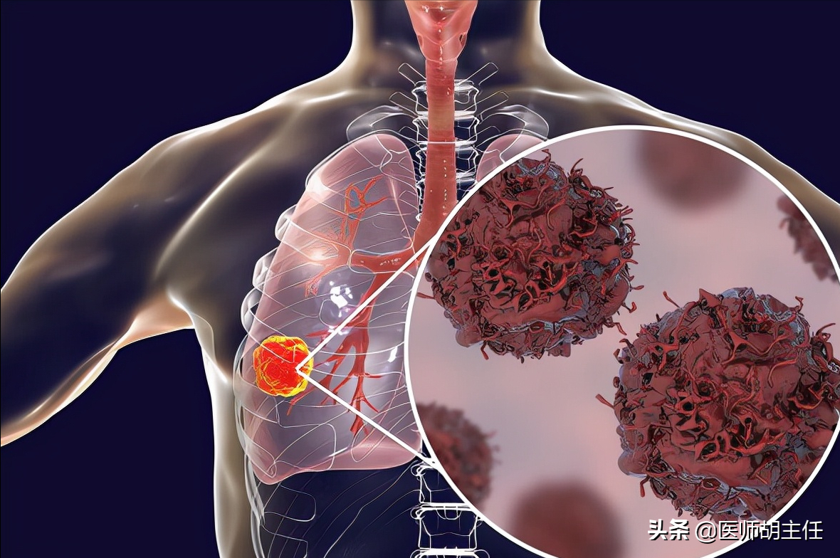 肺部疾病来临前，会先经历3个症状！发现1个，建议及早就医检查