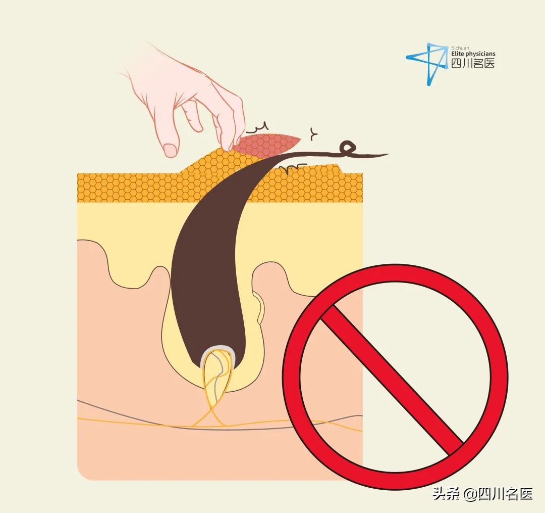 难看的“鸡皮肤”，到底还有没有救？华西皮肤科医生来支招