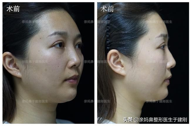 4次玻尿酸隆鼻！杭州美女惨变“阿凡达鼻”，鼻整形后意外逆龄