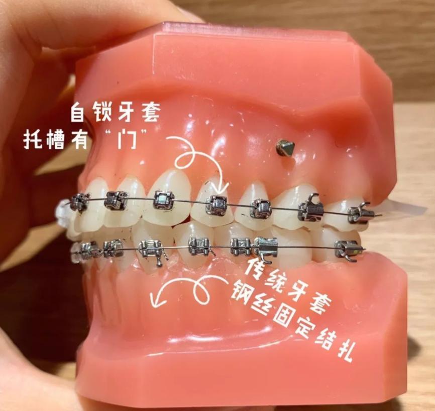 牙套价格一般是多少钱一个 -小蚊子百科网