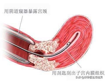 子宫内膜厚多次刮宫 医生：盲目刮宫不可取 宫腔镜检查很有必要