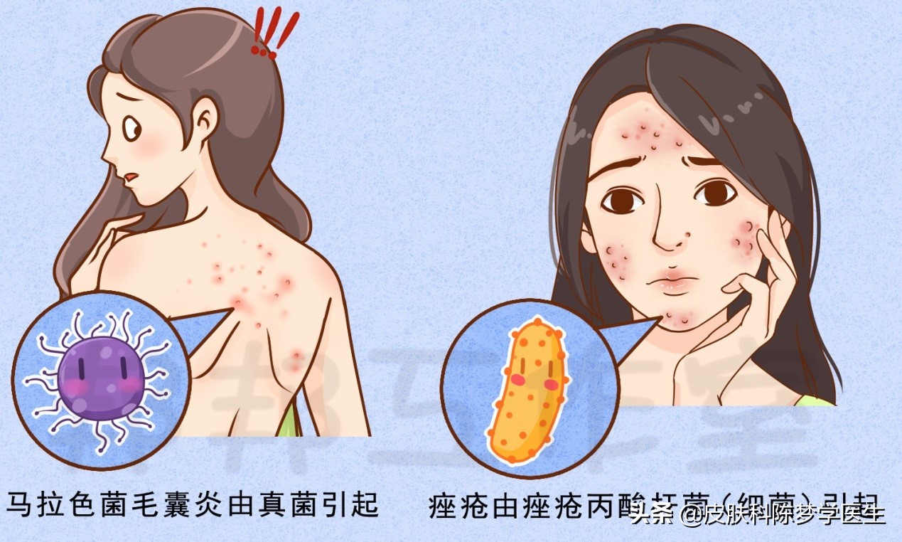 痘痘始终不好，小心是马拉色菌惹的祸