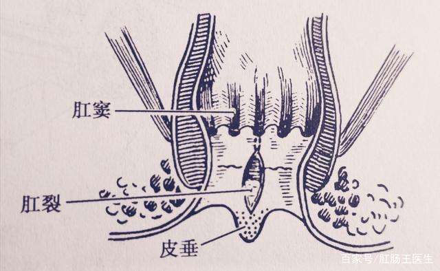 男女老幼皆可发生肛裂,如果以跪趴的姿势检查肛门,那么男性好发于12点
