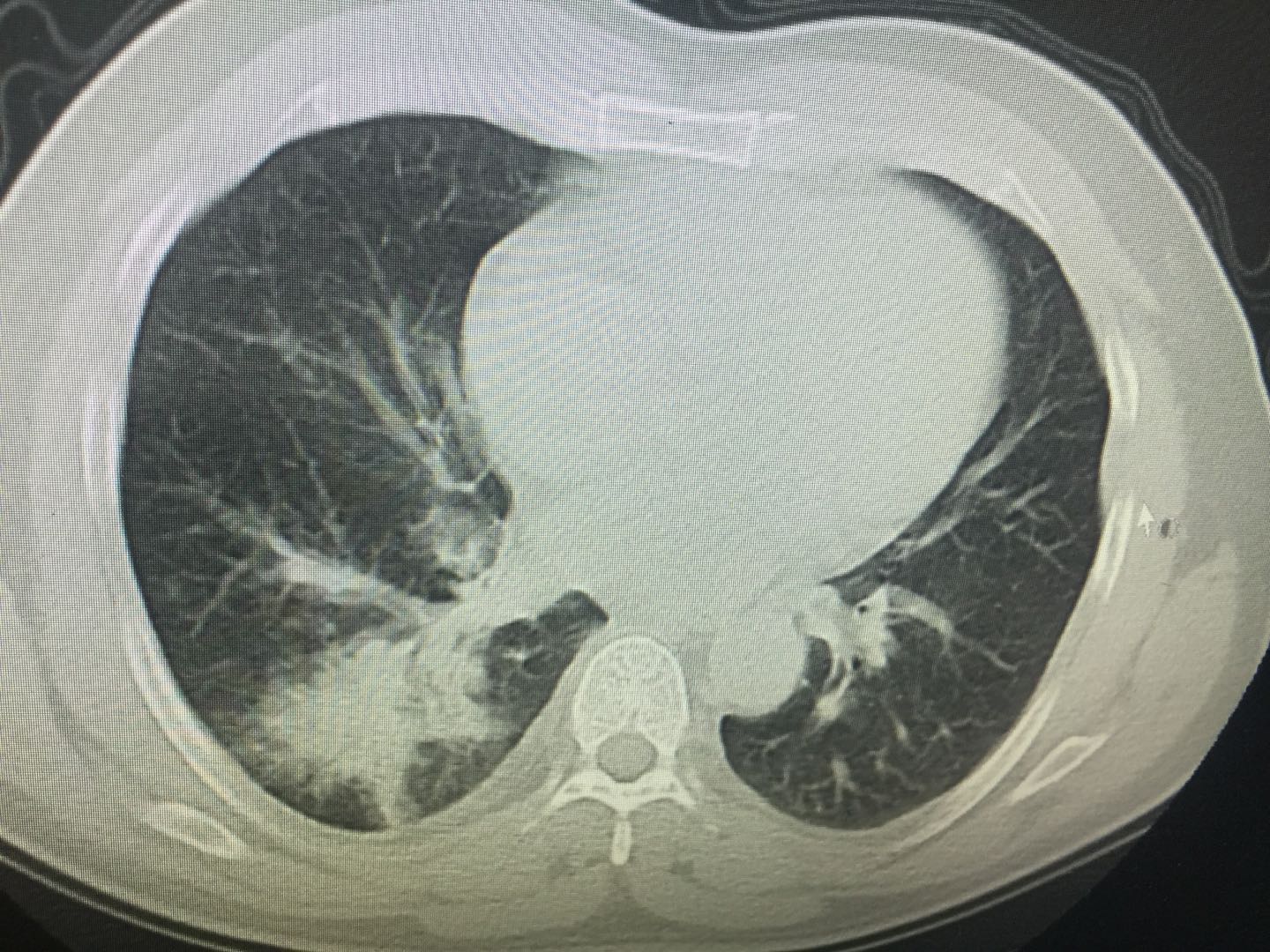 痰中带血,危险大吗?