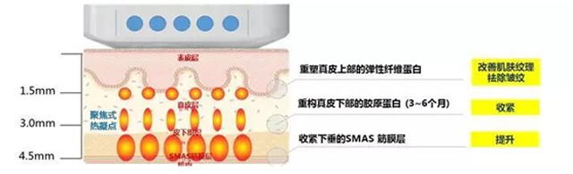 注射、线雕、拉皮、超声刀怎么选？| 北大教授张宗学