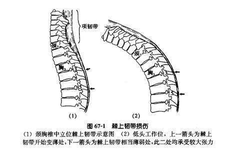 后背中间脊柱疼，不是心脏病，是棘上韧带炎，医生说想根治多运动