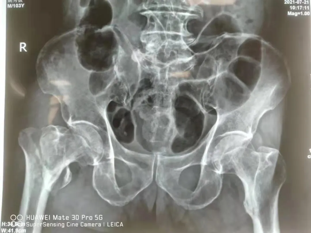 来宾市中医医院成功为103岁老人实施股骨粉碎性骨折钢板内固定术