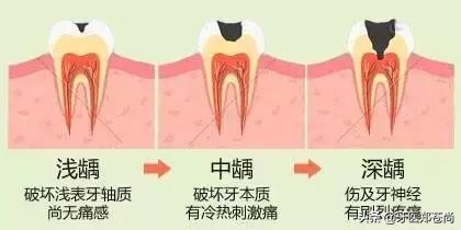 蛀牙烂到神经，就要做根管治疗？