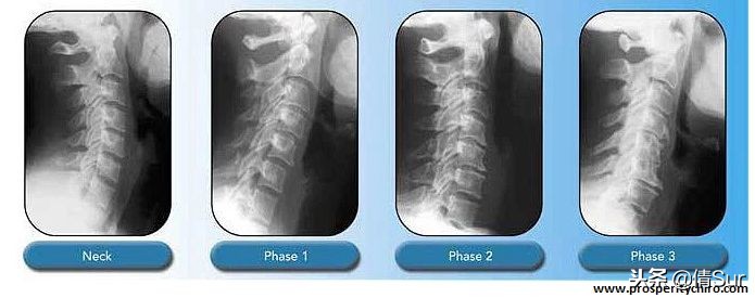 颈椎病—21世纪最大的冤案