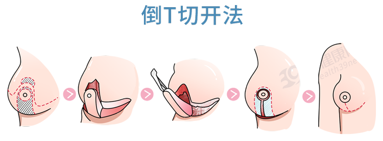 被“巨乳症”折磨的女生，有苦说不出：就像胸前挂着11瓶矿泉水