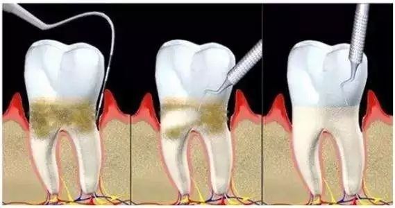 什么是龈下刮治？治疗过程疼吗？会打麻药吗？专业牙医告诉你