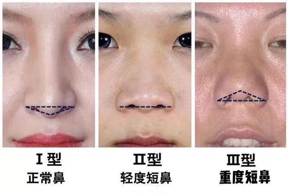 鼻子短(什么是短鼻?短鼻如何改善才更美?