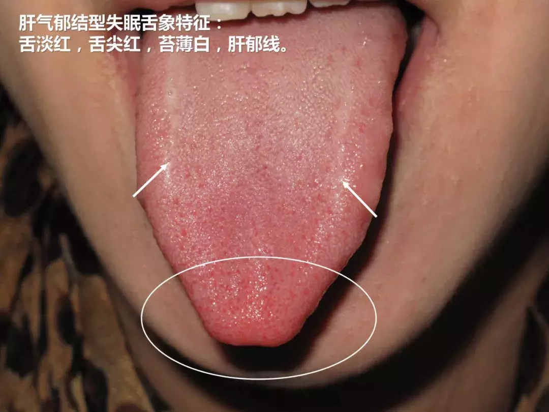 人到中年一觉难求,常常失眠惊醒早醒,中成药按摩并用治疗效果好