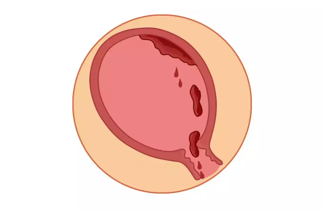 宫腔内有残留的胎盘产后出血是导致产妇死亡的原因首位,不过这种情况