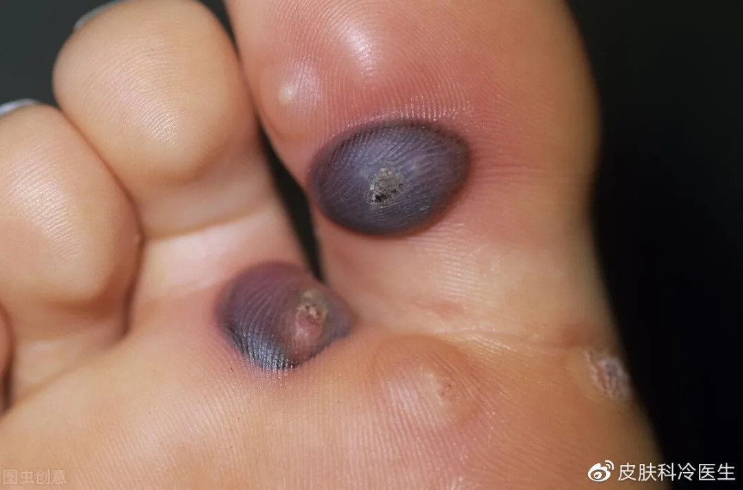 便宜实用且方便:液氮冷冻,了解一下?