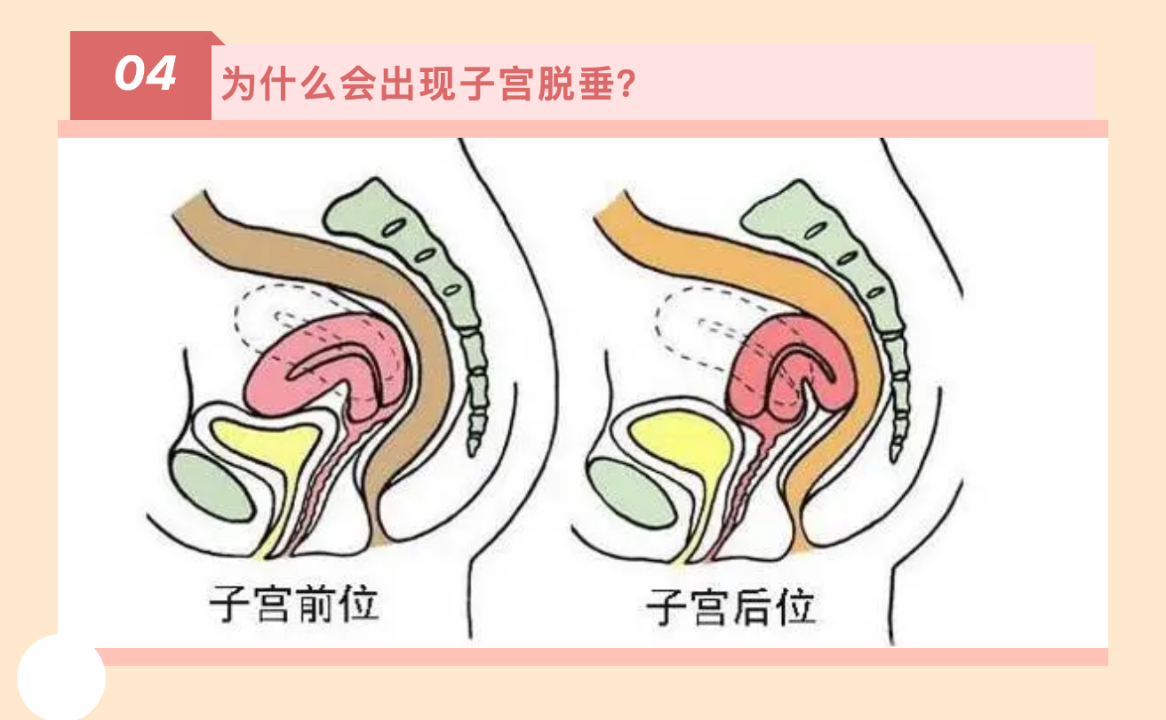 产后小腹总有下坠感，要警惕子宫脱垂啦