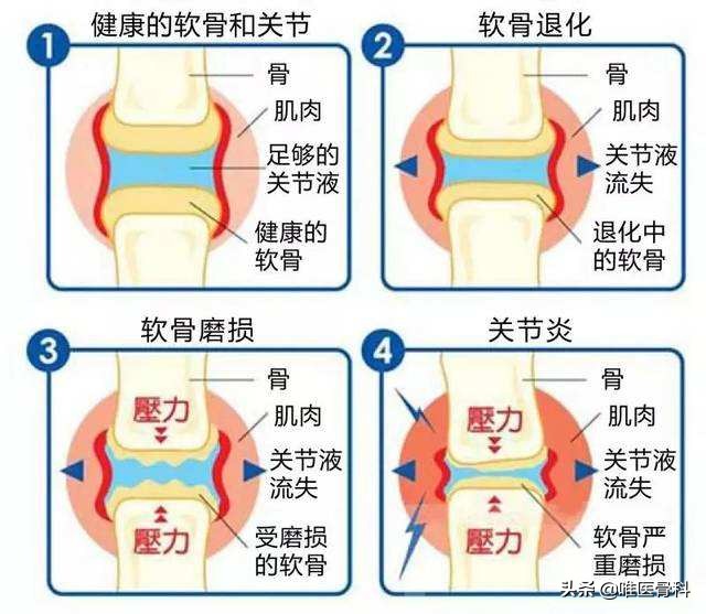 打“玻璃酸钠”对身体会有哪些影响？要注意这 5 点