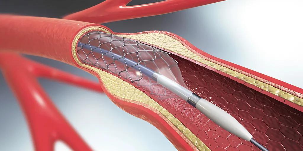 国家出手，心脏支架价格直降95%，但一项最新研究不可不知