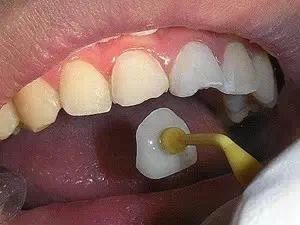 牙缝大，该怎么补救？