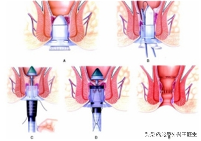 肛门摸到了小肉球，是痔疮还是尖锐湿疣？医生教你从外表就能区分
