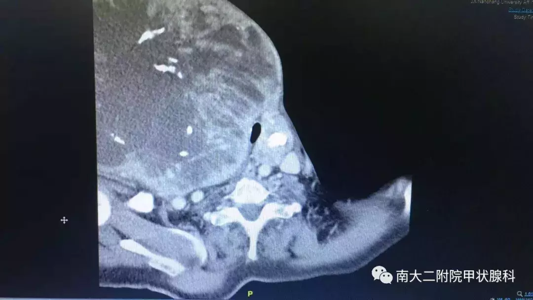 江西甲状腺哪里好(南昌大学二附院甲状腺诊治中心完成重达10斤国内外罕见巨大甲状腺肿瘤切除手术)