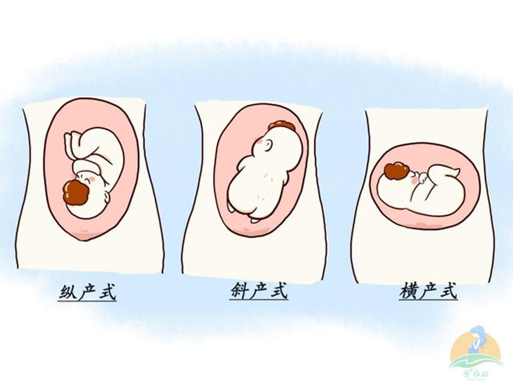 遇上胎位不正的情况，这些纠正方法，孕妈们可以了解一下