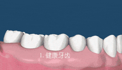 牙龈萎缩修复妙招：有效改善牙龈退缩问题