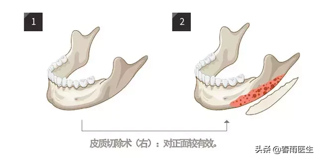 做了削骨手术都会导致脸垮吗？有更好的变美方法吗？专家讲出实话