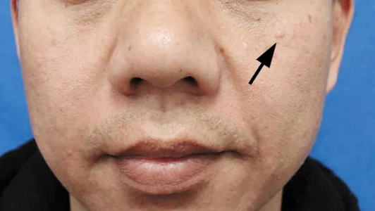 皮肤长了肉疙瘩,不痛不痒,或暗示了4个毛病,及早检查更安心