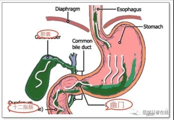 一文读懂胆汁反流