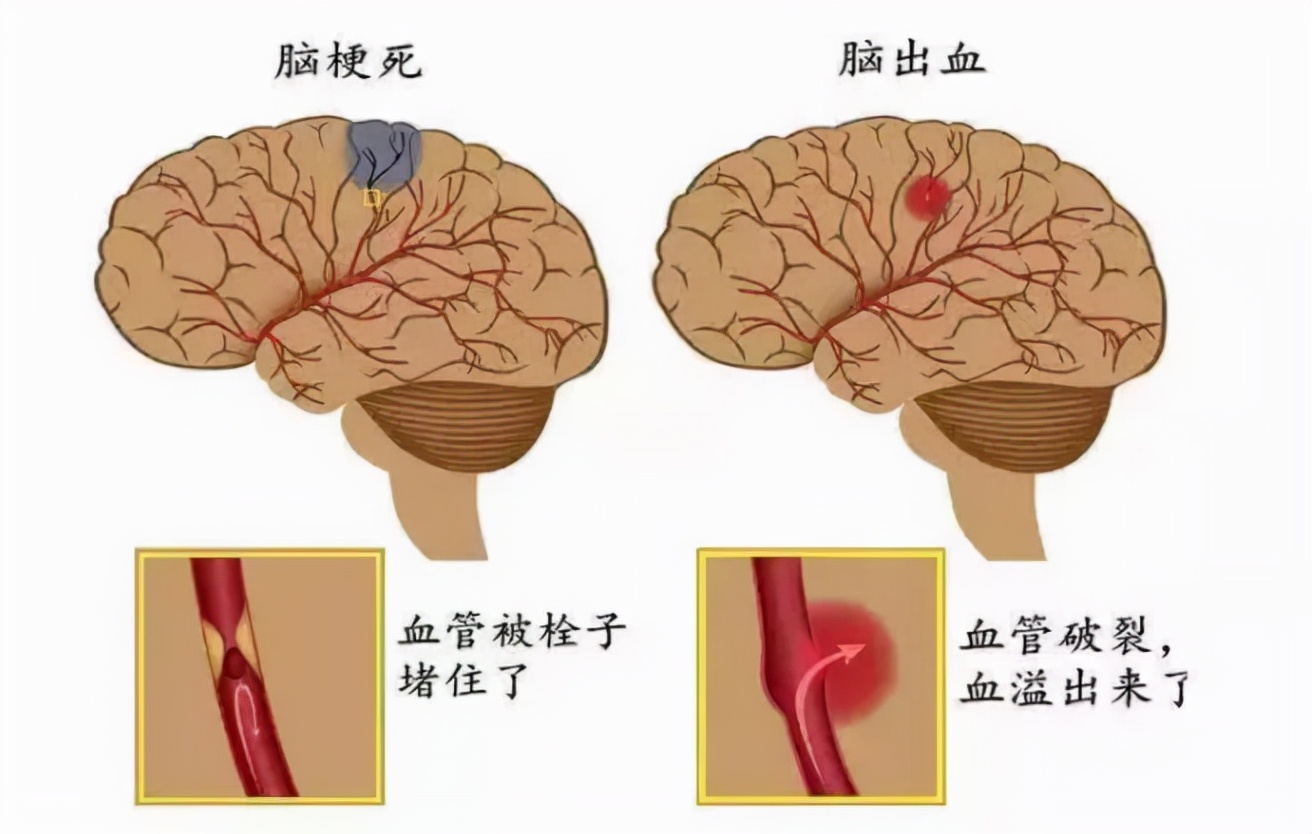 一类是脑出血,叫出血性的脑卒中