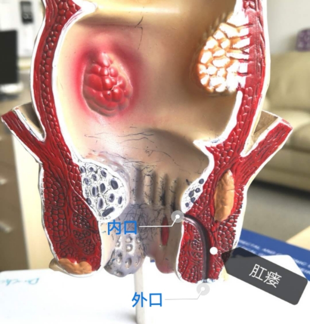 肛瘘是怎么回事?到底要不要手术?