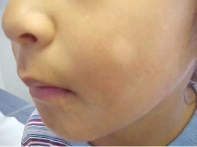 宝宝身上有白斑!不会是白癜风吧?