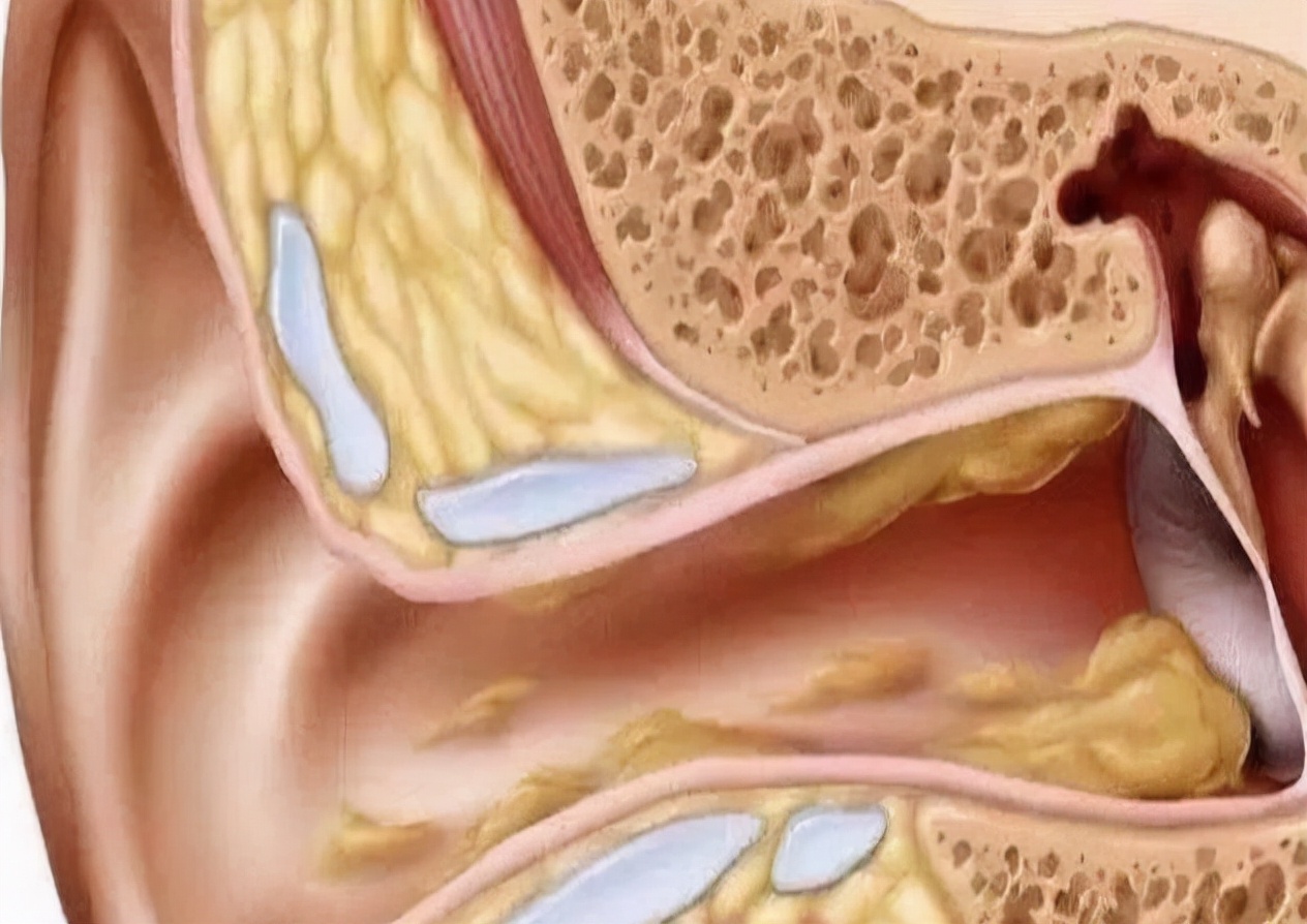 为什么有的人"耳屎"是湿的,有的是干的?可能与这件尴尬事有关