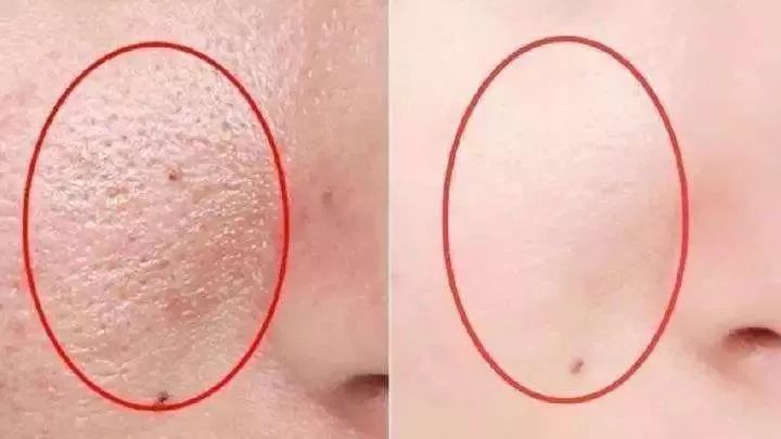 脸上泛红发痒、出油长痘？“螨虫脸”真的很丑，除螨刻不容缓