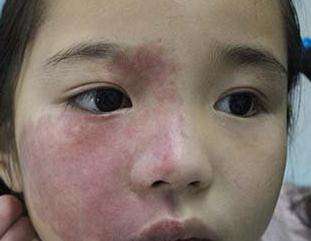 婴儿有红色胎记是怎么回事(宝宝生下来头部有红色胎记怎么办) - 乐宝