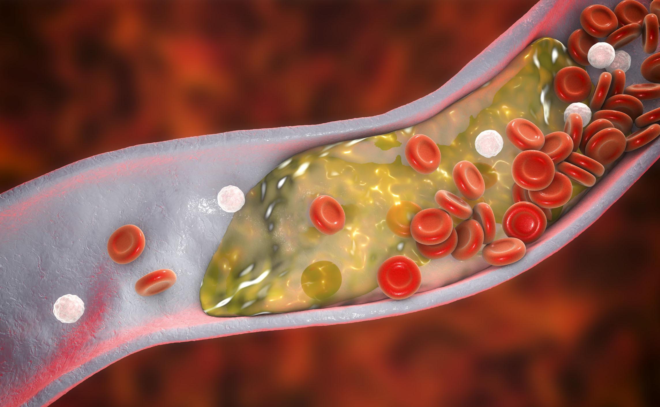 高凝状态是什么意思(血液黏稠度高就是血脂高吗?如何降低血液粘稠度)