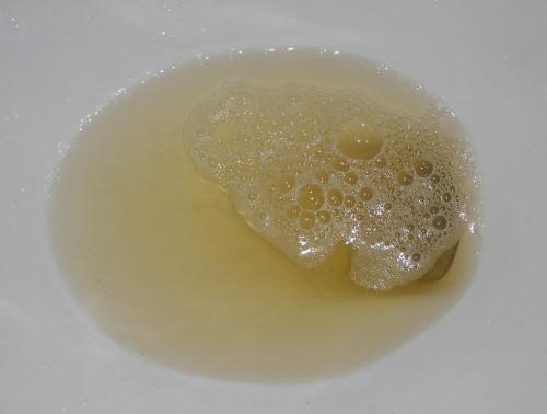 有泡沫尿就是肾脏出现问题了吗?医生坦言:这可不一定