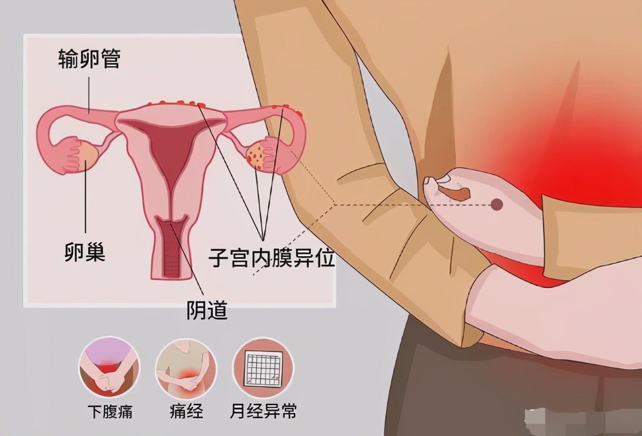 子宫内膜异位症还能怀孕吗？这个女生的经历说明了一切