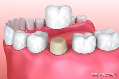 为什么做牙冠修复还要打桩？患者是后牙严重缺损