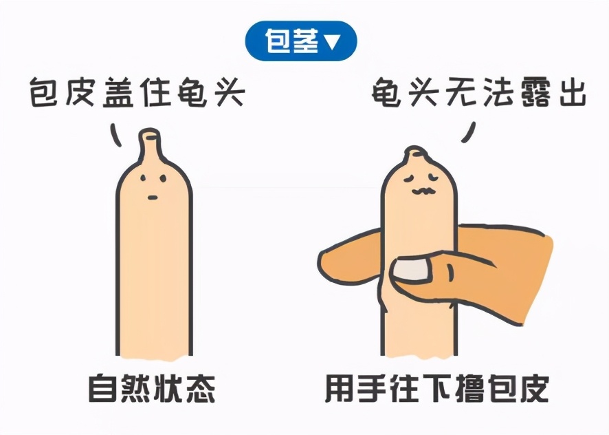 包皮环切术,但是如果是包茎的话就还是强烈建议来医院进行包皮环切