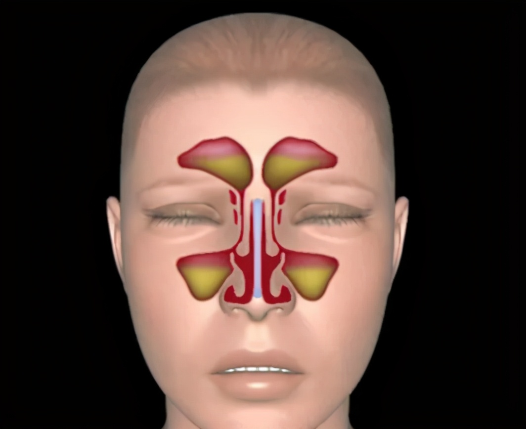出现这两种症状，你的鼻炎可能已经变成了鼻窦炎