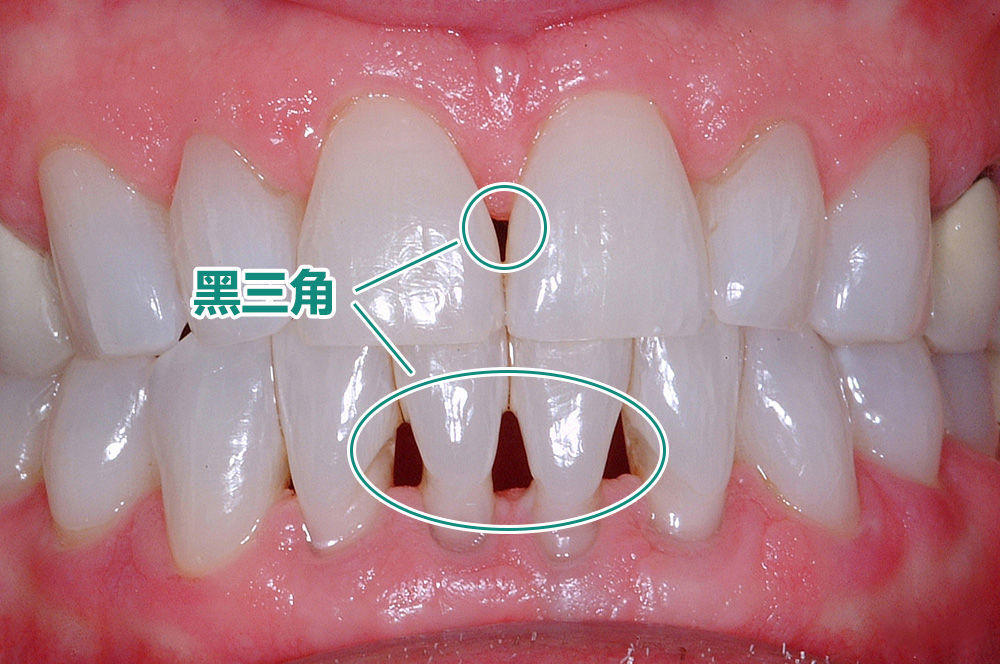 牙齿黑渍黑三角怎么办？简单有效去除方法分享